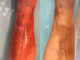 糖尿病下肢水肿平衡针灸三次临床治愈